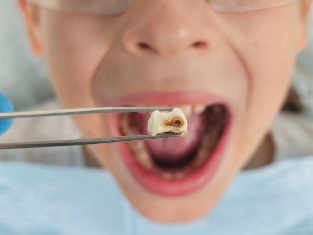 Best Emergency Dentist for Knocked-Out Tooth in Orangetree, FL